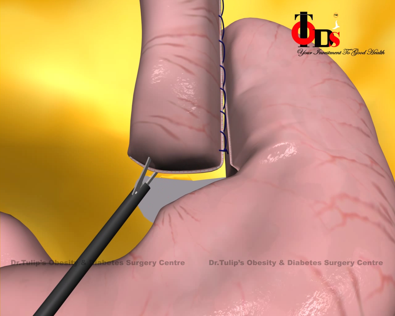  Haital Hernia surgery